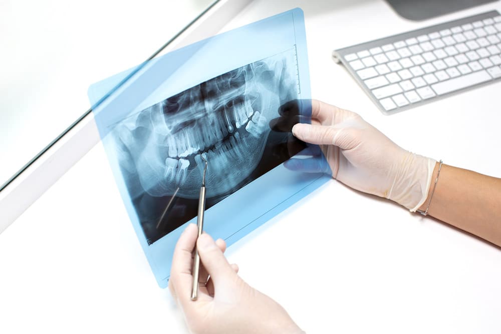Root Canal Treatment In Dubai UAE NLV Medical Center