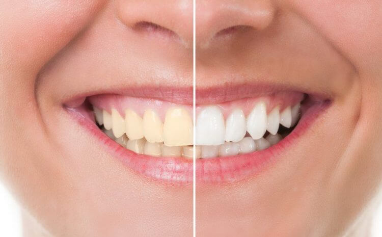 What foods to avoid after teeth whitening