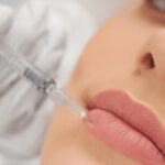 Cosmetic Lip Fillers - NLV medical Center Dubai https://nlvmedicalcenter.ae/